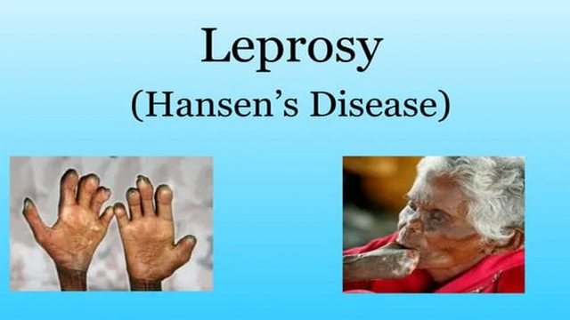 Leprosy